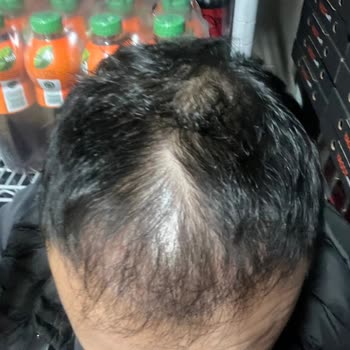 Antalya Medical Park Saç Ekimi