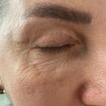 Luvimed Clinic Luvimed Ataşehir Gözaltı Dolgusundan Memnun Değilim