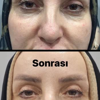 Luvimed Clinic Luvimed Ataşehir Gözaltı Dolgusundan Memnun Değilim