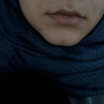 Bioderma Atoderm Nemlendirici Aşırı Sivilce Yaptı