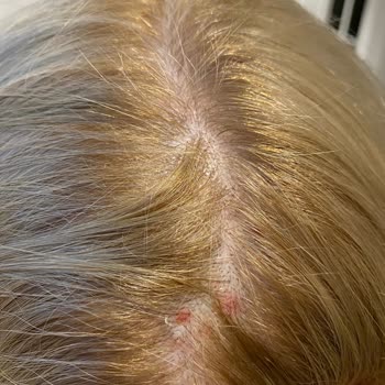 Palette Saç Derimi Yaktı!