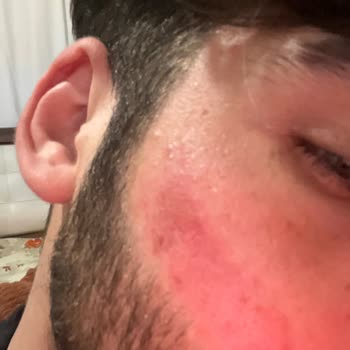 Veet Cildim Tahriş Oldu