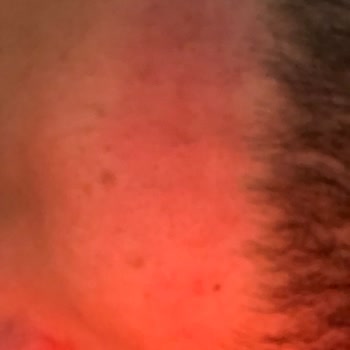 Veet Cildim Tahriş Oldu