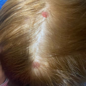 Palette Saç Boyası Saç Derimde Yaralar Çıkardı!