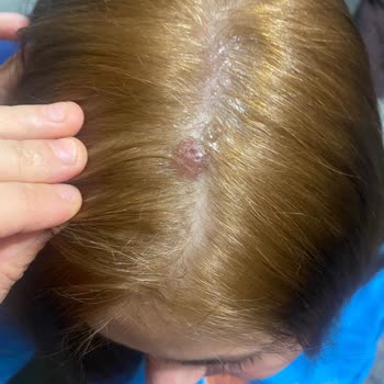 Palette Saç Boyası Saç Derimde Yaralar Çıkardı!