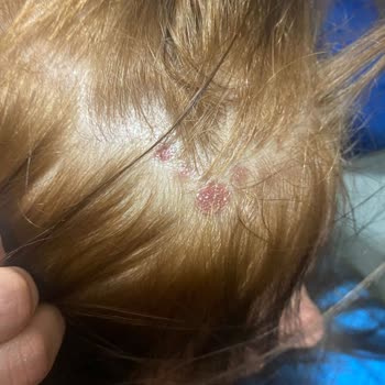 Palette Saç Boyası Saç Derimde Yaralar Çıkardı!