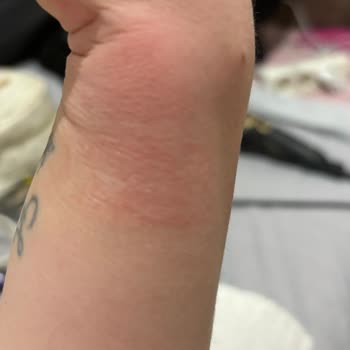 Apple Watch 9 Alerji Yaptı