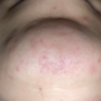 The Purest Solutions Yüzüm Pul Pul Döküldü Ve Sivilcelendi?