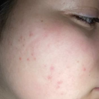 The Purest Solutions Yüzüm Pul Pul Döküldü Ve Sivilcelendi?