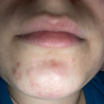 The Purest Solutions Yüzüm Pul Pul Döküldü Ve Sivilcelendi?