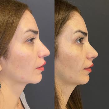 Luxen Wellness Clinic Alaycı Diyalog Ve İşlem Sonrası Bir Değişimin Olmaması