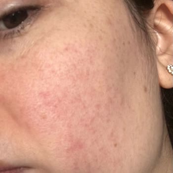 Nurederm Kozmetik Alerjik Kore Kremi