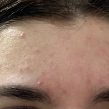 Caudalie Vinopure Serum Cildimi Mahvetti