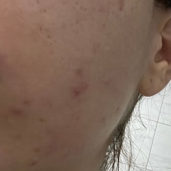 Caudalie Vinopure Serum Cildimi Mahvetti