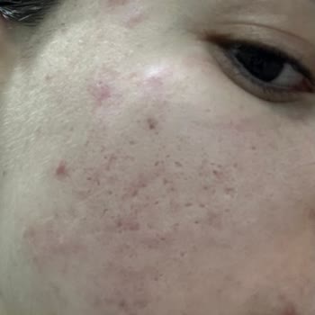 Caudalie Vinopure Serum Cildimi Mahvetti