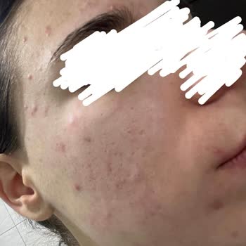 Caudalie Vinopure Serum Cildimi Mahvetti