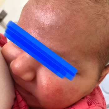 Mustela Şampuan Alerji Yapıyor