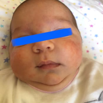 Mustela Şampuan Alerji Yapıyor