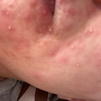 Mia Klinika Fazlasıyla Sivilce Yaptı