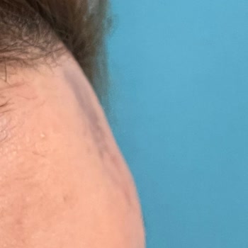 Dr.Özge Aydın Klinik Uygulamaları Sonrası Yaşanan Cilt Problemleri