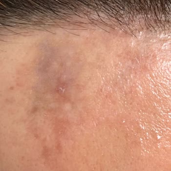 Dr.Özge Aydın Klinik Uygulamaları Sonrası Yaşanan Cilt Problemleri