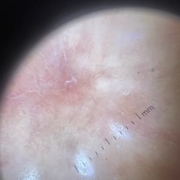 Dr.Özge Aydın Klinik Uygulamaları Sonrası Yaşanan Cilt Problemleri