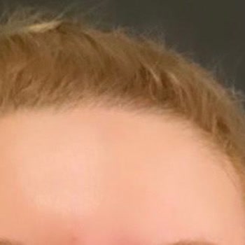 Dr.Özge Aydın Klinik Uygulamaları Sonrası Yaşanan Cilt Problemleri