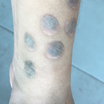 Ayten Kömürcü Kalıcı Makyaj Stüdyosu Sosyal Medyada Yankı Bulan Dövme Silme Problemleri