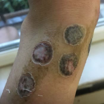 Ayten Kömürcü Kalıcı Makyaj Stüdyosu Sosyal Medyada Yankı Bulan Dövme Silme Problemleri