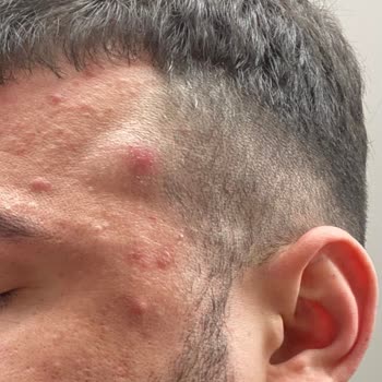 Selin Beste Kan Güzellik Moss Bakım Dedikleri Şey İle Yüzümü Mahvettiler