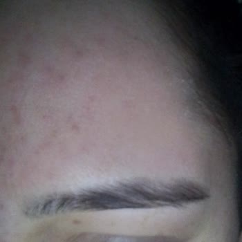 Claderm Kil Maskesi Yüzümü Mahvetti