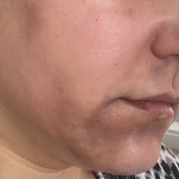 Selin Beste Kan Güzellik Yüz Bakımı Sonrası Yaşanan Sorunlar Ve Müşteri Pişmanlığı