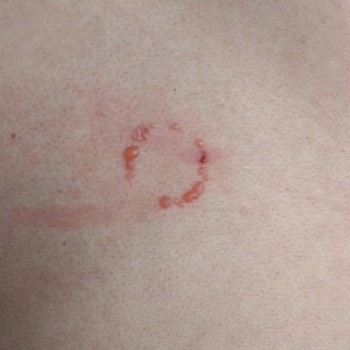 Buhara Hastanesinde Enfeksiyon Kaptım.