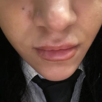 Bahar Acar Güzellik Merkezi Hatalı Yapılan İşlem