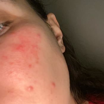Bioderma Cildimde Hassasiyeti Ve Kızarıklığı Arttırdı
