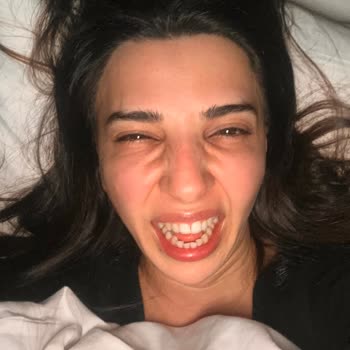 Betül Ökkan Estetik Merkezi Yanlış Masseter Botoksu Uygulaması