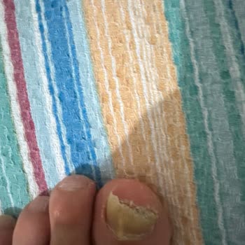 Yaşam Güzellik Merkezi (Batman) Tırnak Mantarı Sonucu