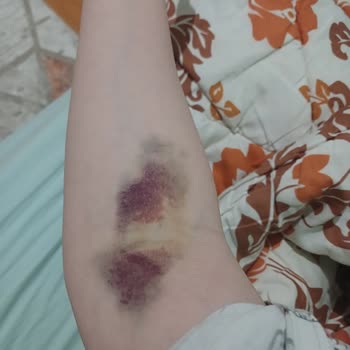 Farabi Hastanesi (Konya) Serum Sonrası Kolda Morarma