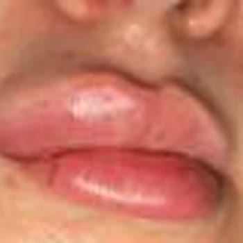 Hospitadent Yanlış Tedavi Süreci Eksik Bilgilendirme