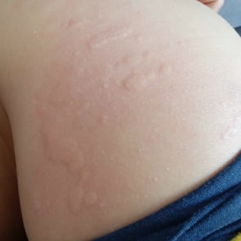 Enterogermina Kids Alerjiye Sebep Oldu