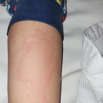 Enterogermina Kids Alerjiye Sebep Oldu