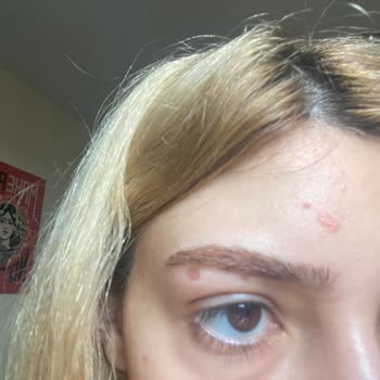 Palette 10.1 Derimde Yanıklara Ve Yaralara Neden Oldu