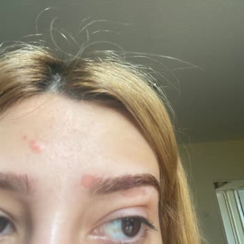 Palette 10.1 Derimde Yanıklara Ve Yaralara Neden Oldu