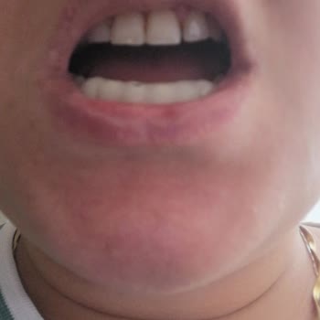 Çorlu Ağız ve Diş Sağlığı Merkezi Porselen Diş Hatası