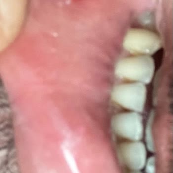 Parodontax Gum Protection Toothpaste Side Effects