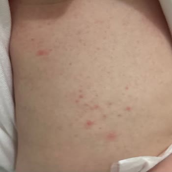 Mustela Kremleri Alerjiye Neden Oldu