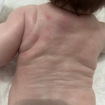 Mustela Kremleri Alerjiye Neden Oldu