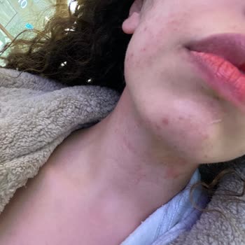 Yves Rocher Alerjik Sorun Karşısında Yaşadıklarım