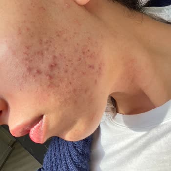 Yves Rocher Alerjik Sorun Karşısında Yaşadıklarım