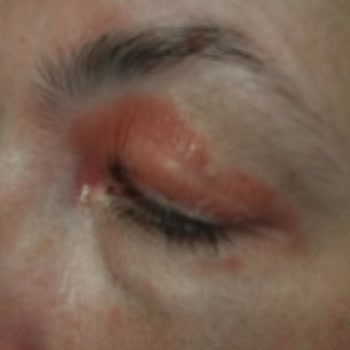 Ducray Göz Egzama Kremi Kötülüğü